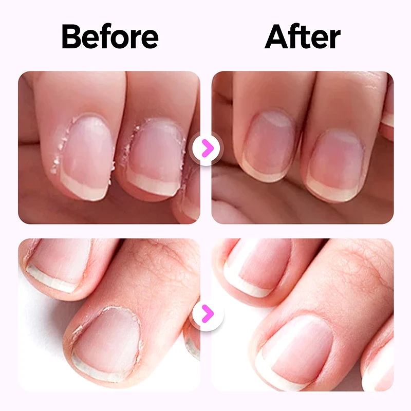 🔥✨Kaufe 1 und erhalte 1 gratis 💜2025 Neuer und verbesserter 3-in-1-Nagelpflegestift.
