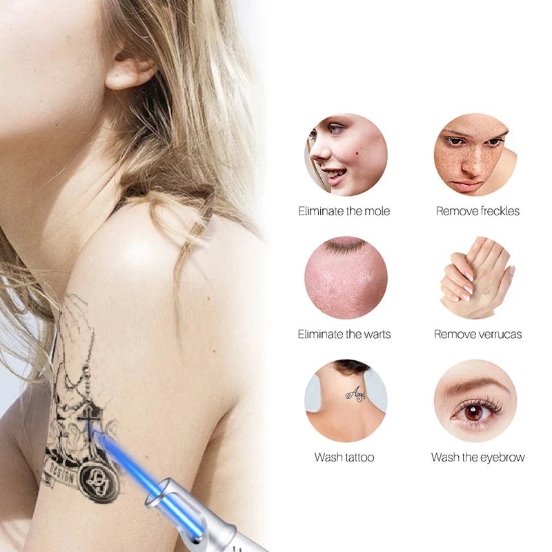 Skanto | Intelligenter Tattoo-Entfernungs-Laserstift - Entfernt Muttermale, Sommersprossen, Akne, Tattoos