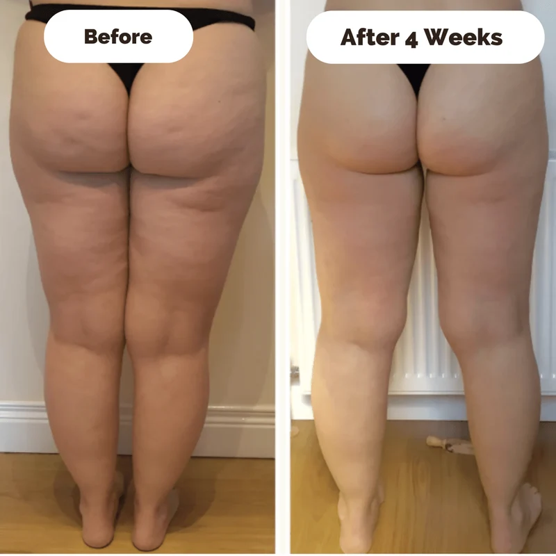 Skanto | Hautstraffendes Massagegerät gegen Cellulite